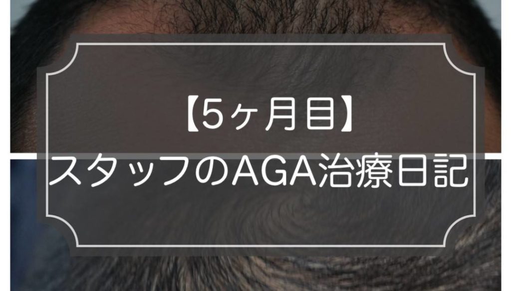【5ヶ月目】AGA治療の経過ブログ